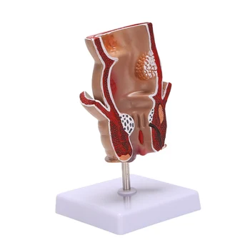  Anatomijos Modelis Žmogaus Tiesiosios Žarnos Hemorrhoid Pralaimėjimai Modelis Hemorrhoid Fistula Fistula Plyšio Patologija Mokymo Modelį